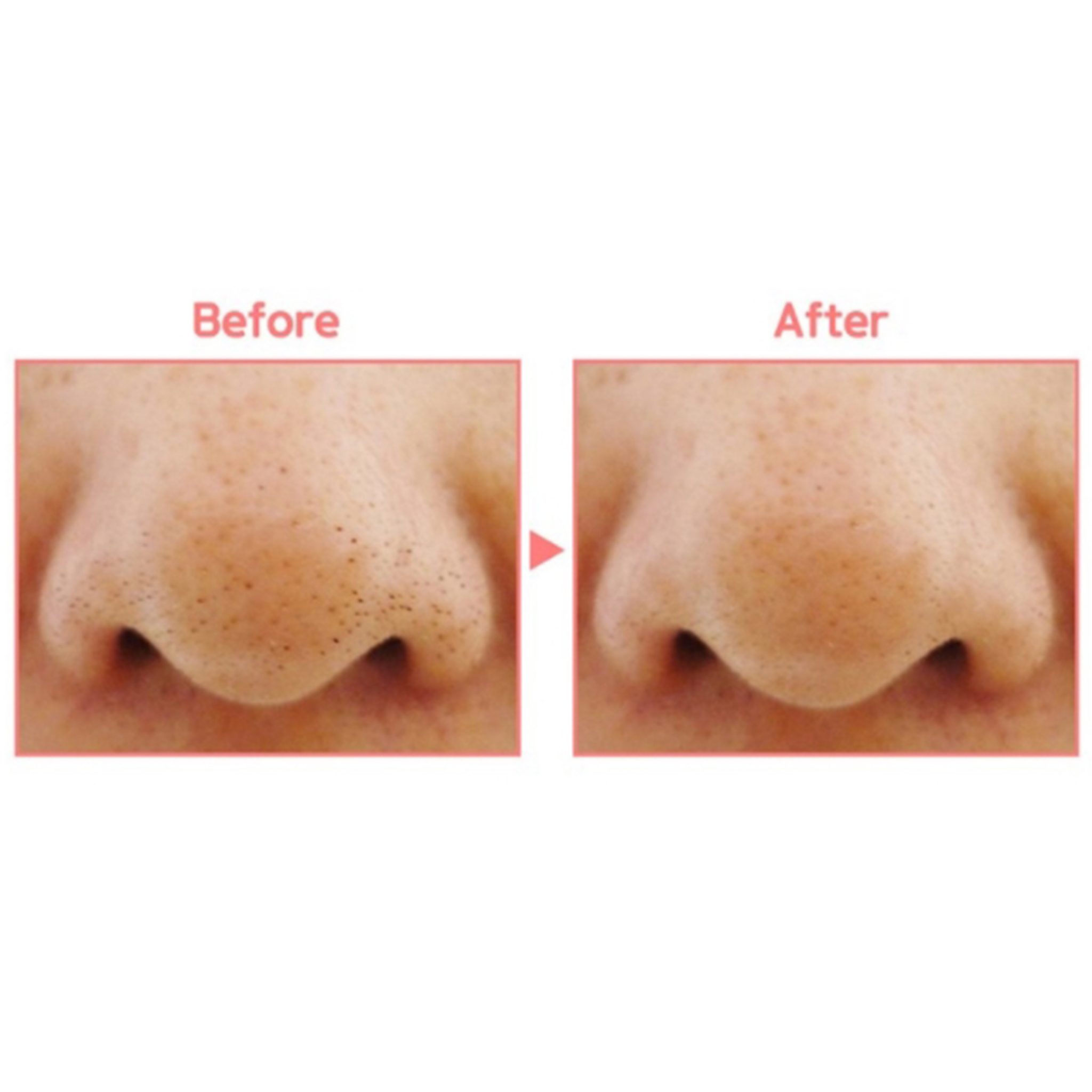 sebum extractor